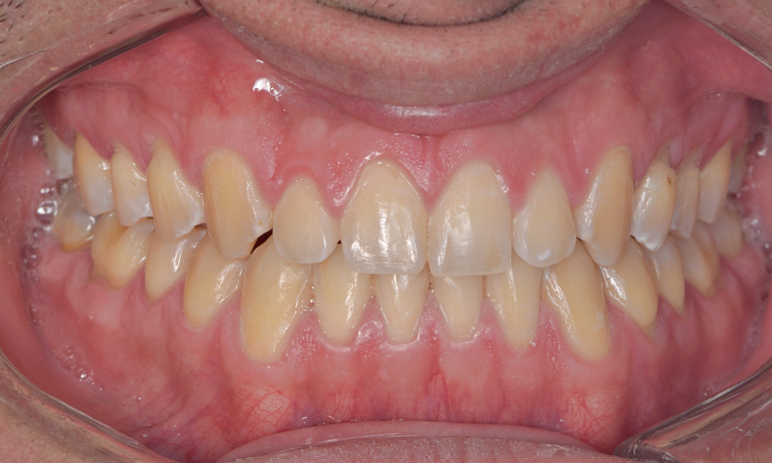 1 frontal