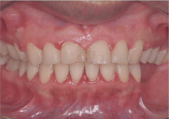 CASO 1 - ANTES_Estética Dental