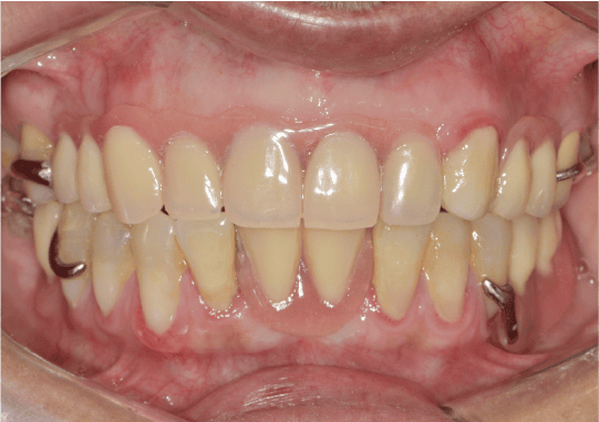 CASO 4 - Rehabilitacion-DESPUES_opt